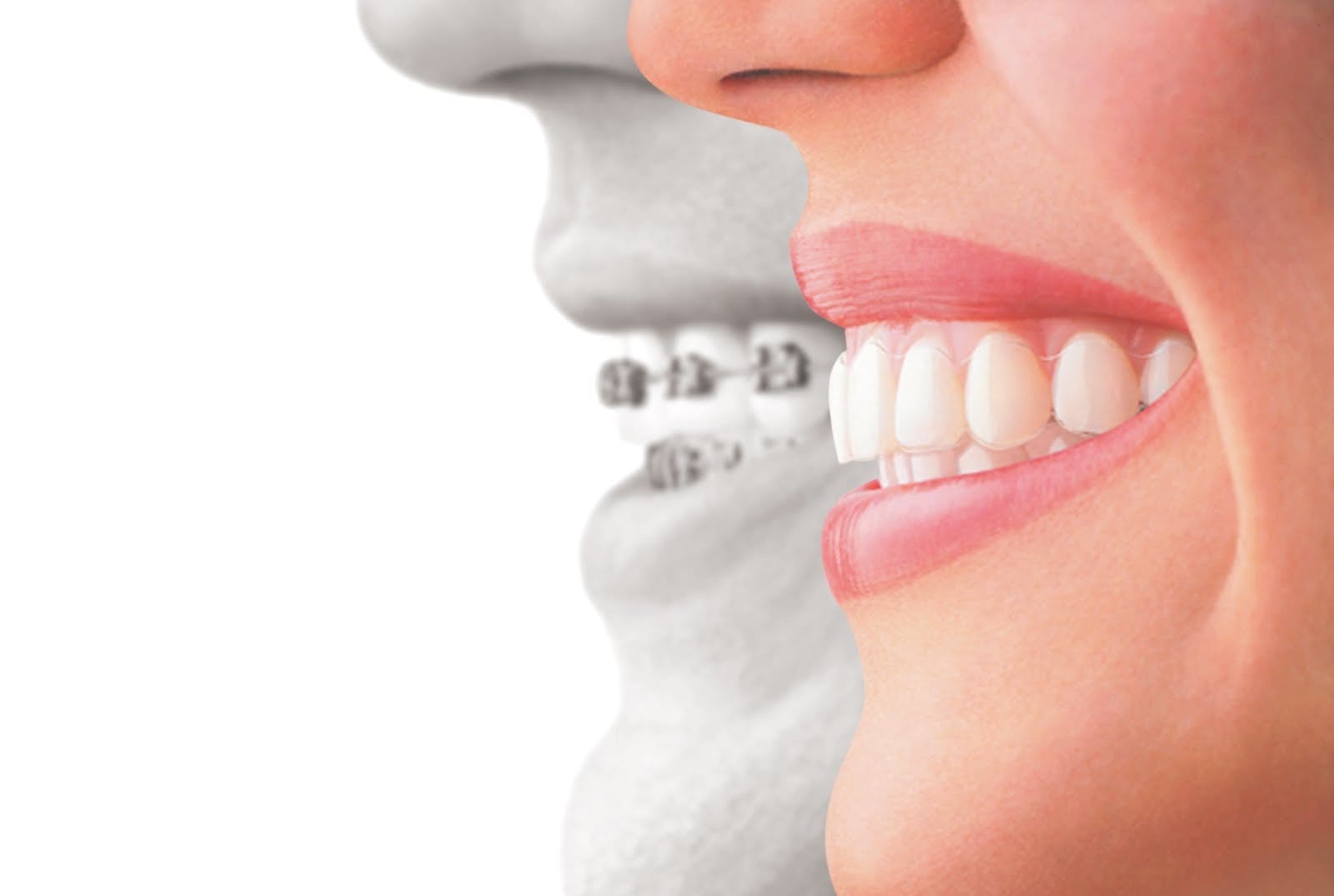 Clear Aligners