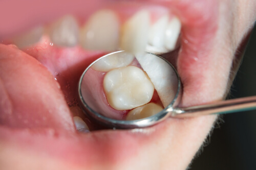 white fillings