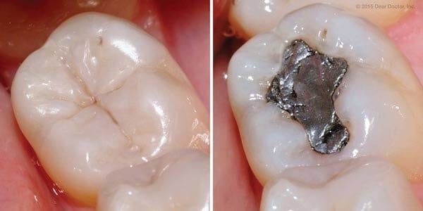 amalgam vs composite fillings