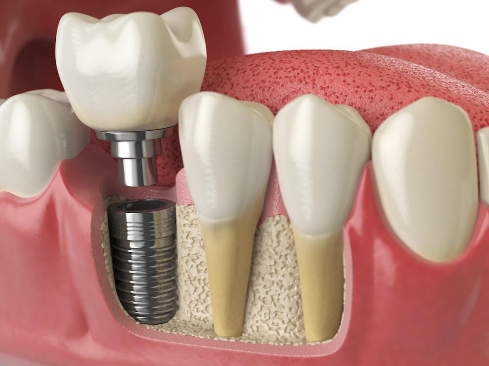 dental implant example