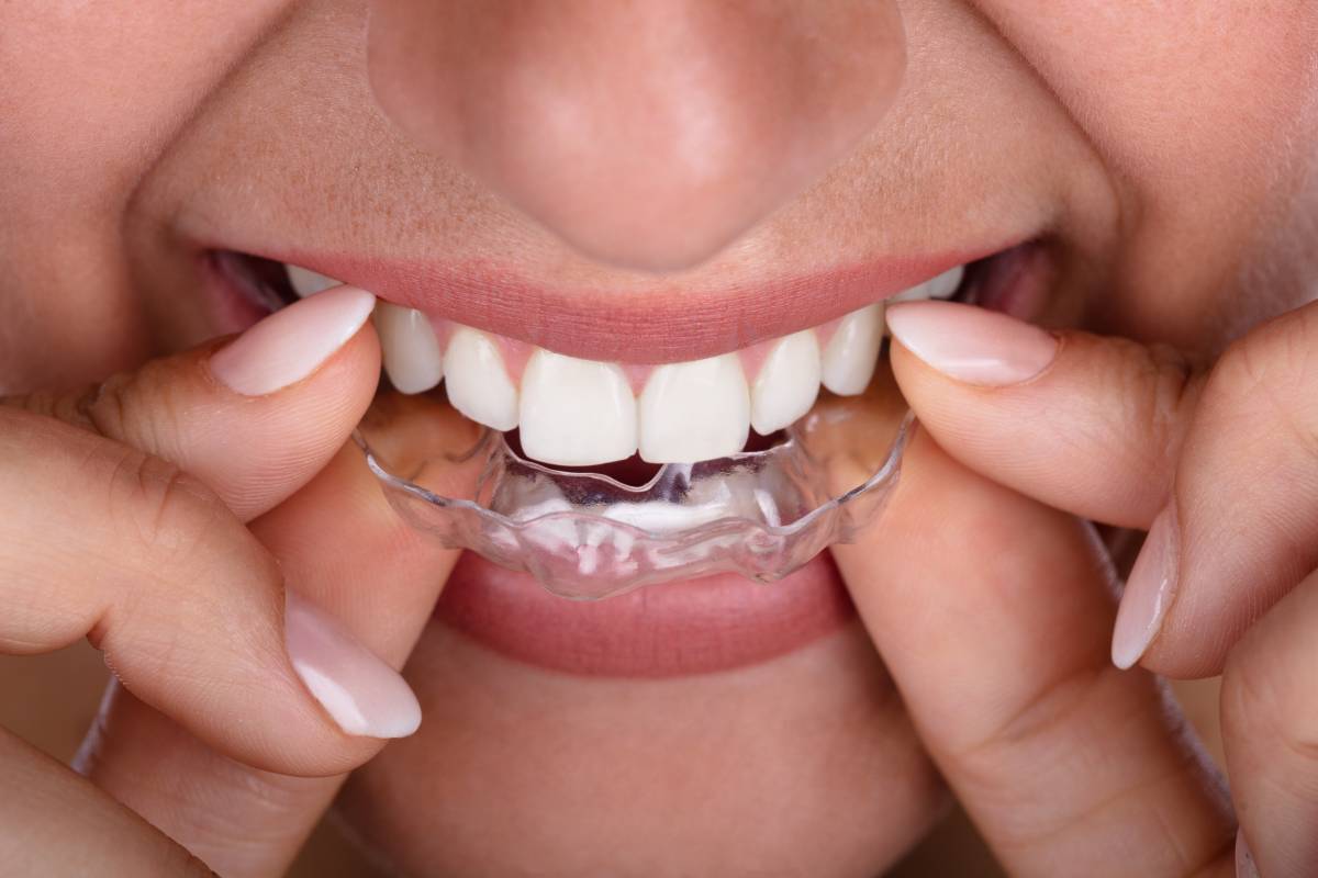 Inserting Clear Aligners